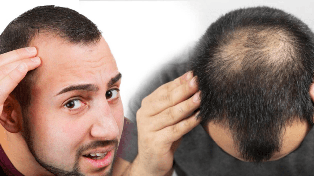 Cara Melebatkan Rambut Botak Pria, Metode yang Terbukti Efektif Menurut Ahli