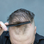 Cara Menumbuhkan Rambut Pria: Tips Mengatasi Rambut Tipis dan Botak 10 Pria