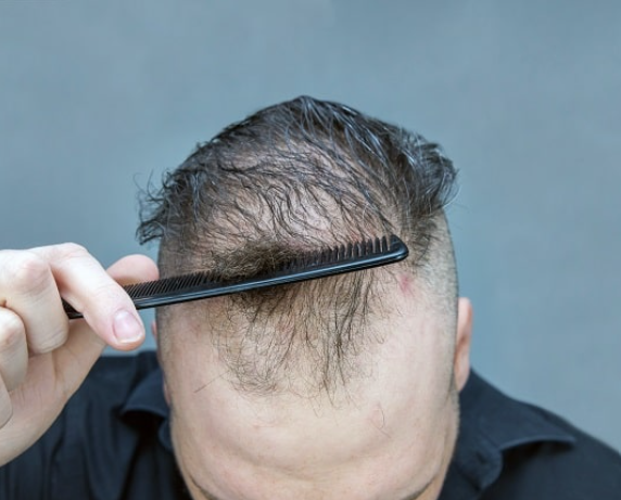 Cara Menumbuhkan Rambut Pria: Tips Mengatasi Rambut Tipis dan Botak 1 Cara Menumbuhkan Rambut Pria: Tips Mengatasi Rambut Tipis dan Botak